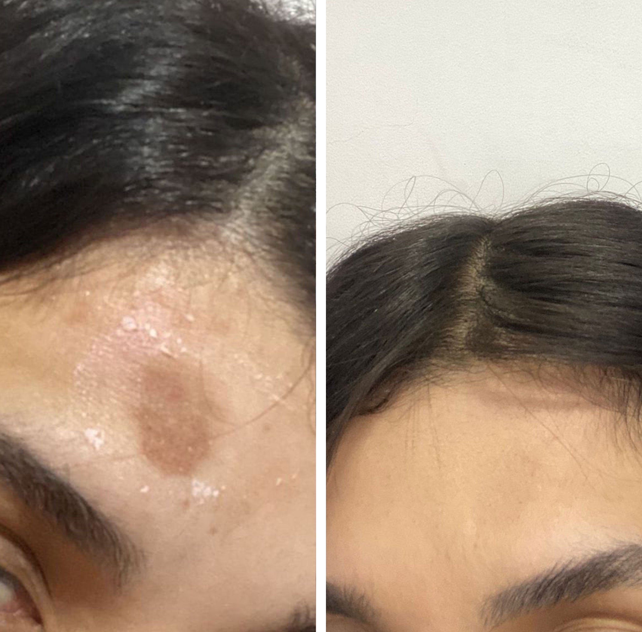 Antes e Depois Melasma e Manchas Faciais