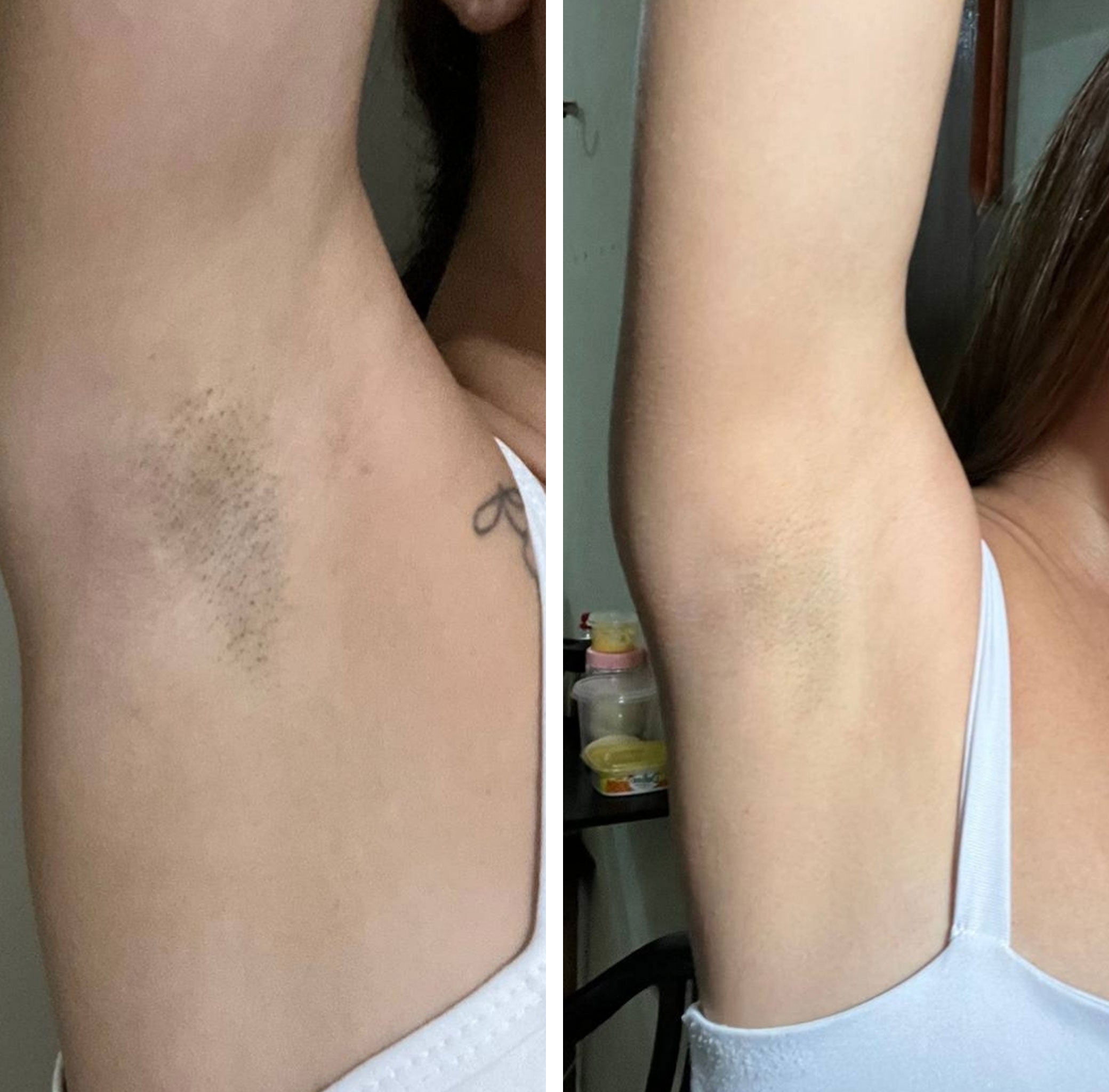 Antes e Depois Foliculite e Textura Corporal